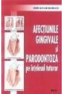Afectiunile gingivale si parodontoza pe intelesul tuturor