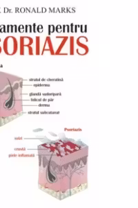 Tratamente pentru psoriazis