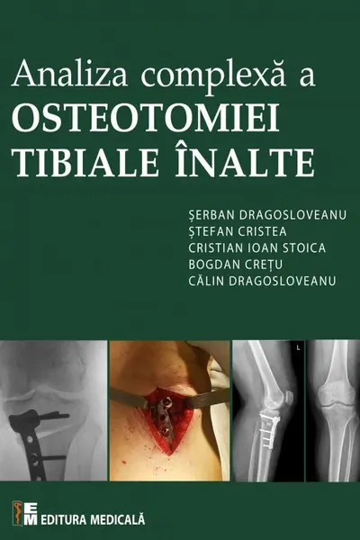 Analiza complexă a Osteotomiei Tibiale Înalte