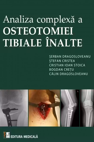 Analiza complexă a Osteotomiei Tibiale Înalte