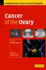 Cancer of the Ovary